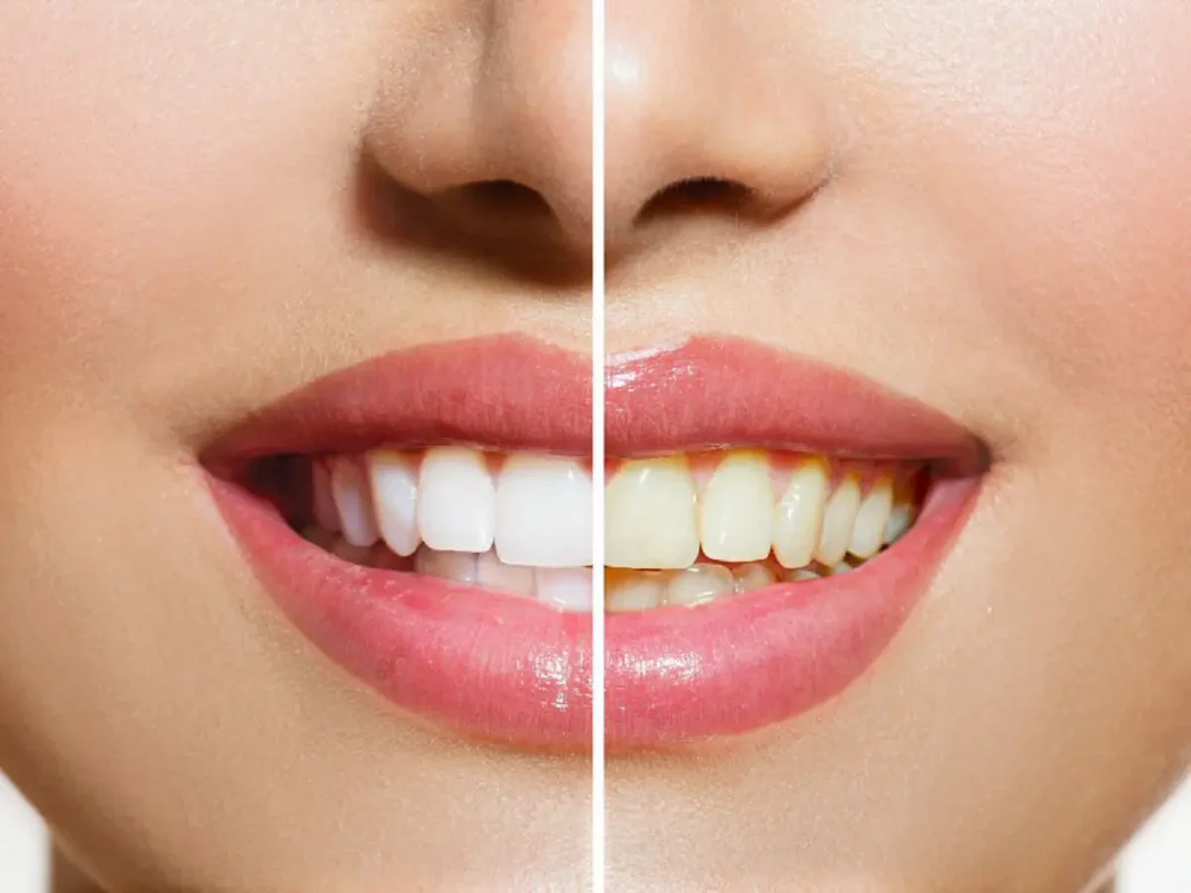 dents-blanches_jpg_be73fca8-d0a6-4228-b70b-11c800e2eaf6